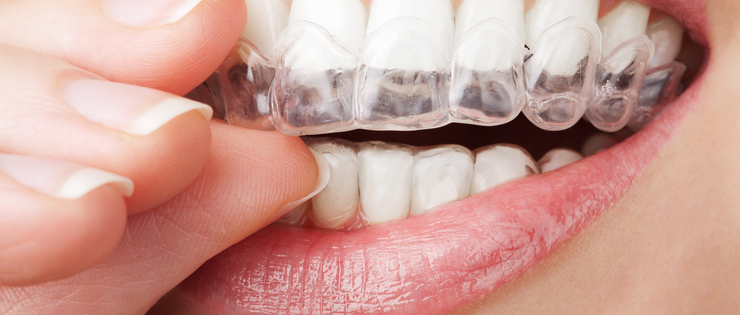 Dental Health Article by Dr Emma - "Cleaning Retainers" 
