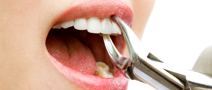 Dental Health Article by Dr Emma - "Just Pull It Out" 