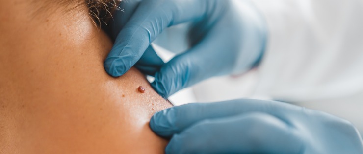 Doctor examining a mole on a woman's back to check for signs of skin cancer.